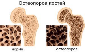 Остеопороз и имплантация